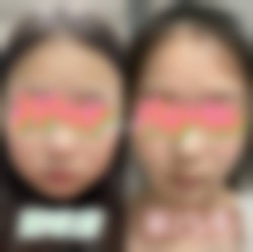 五、面部吸脂的风险与应对