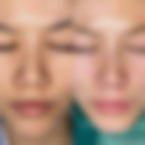 揭秘自体软骨10年+不塌的真相！