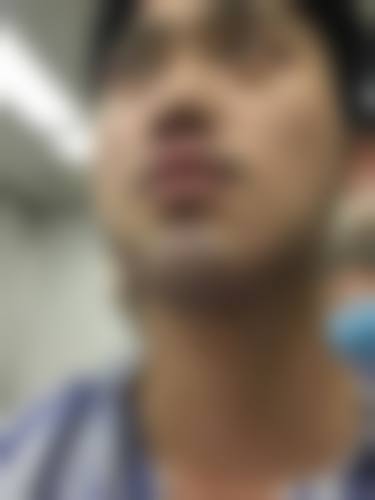 七、深圳大麦微针植发诊疗项目
