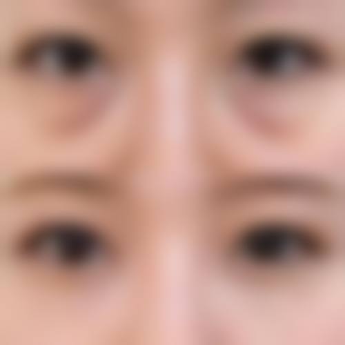 五、医美去眼袋多久可以修复