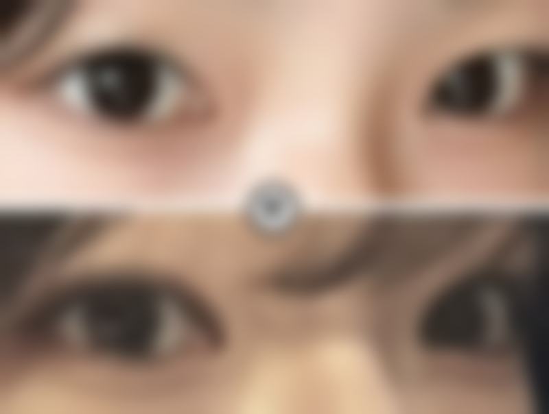 三、医美去眼袋有成效吗