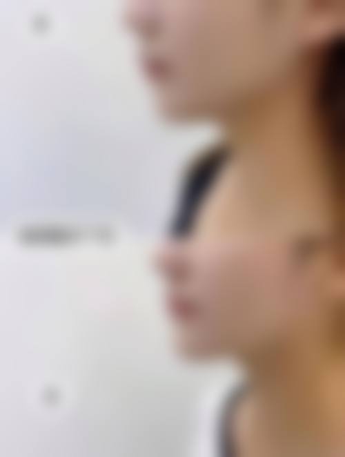 三、激光治疗促进阴道紧缩