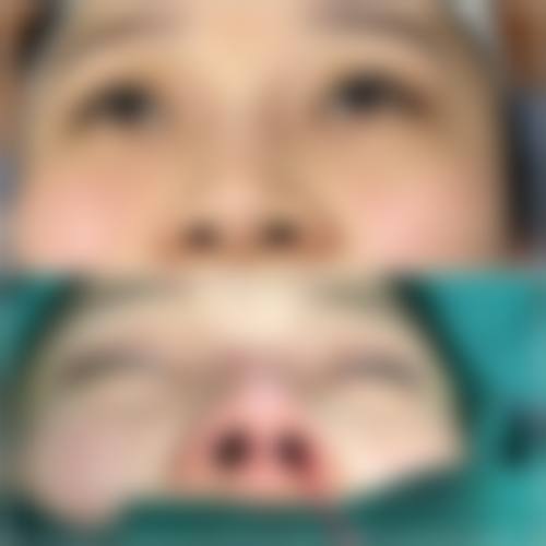 自体耳软骨隆鼻会吸收吗？专家揭秘5%-15%吸收率真相，术后10年效果实测！