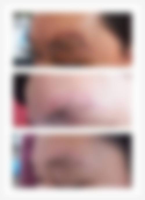 四、激素注射+点阵激光联合治疗成效如何