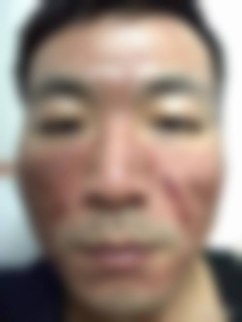 七、怎么判断自己是否适合激素注射+点阵激光联合治疗