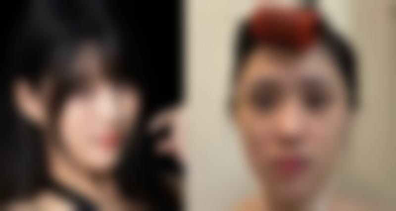 陈博医生为何说割双眼皮修复率高达 15%？