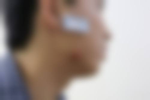 二、探秘疤痕疙瘩的药物去除之道