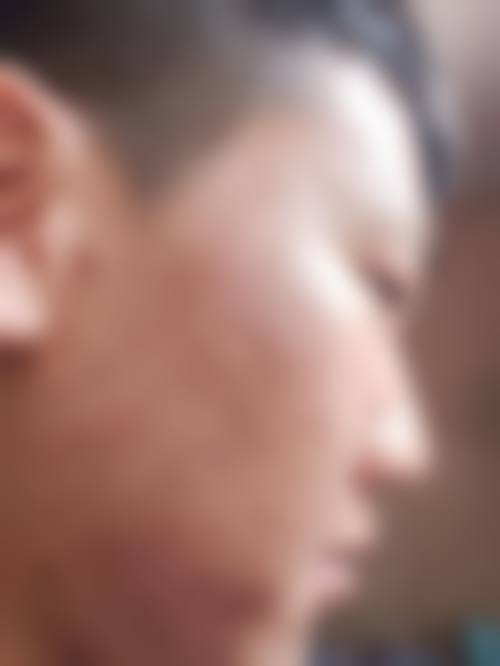 五、去除脸上疤痕价格一般多少