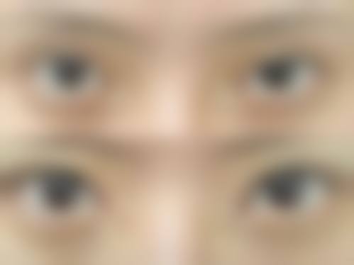 七、双眼皮紧致手术价格影响因素
