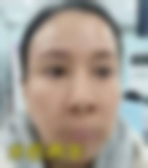 二、杨迪医生的眼周筋膜提升术优势
