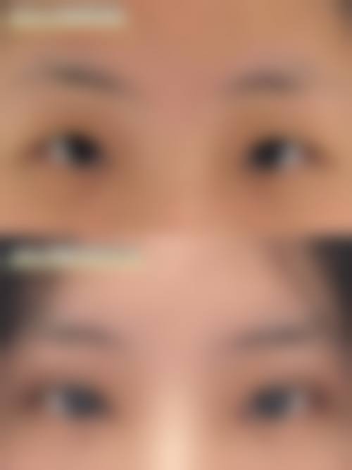二、双眼皮修复后眉眼太近能否修复