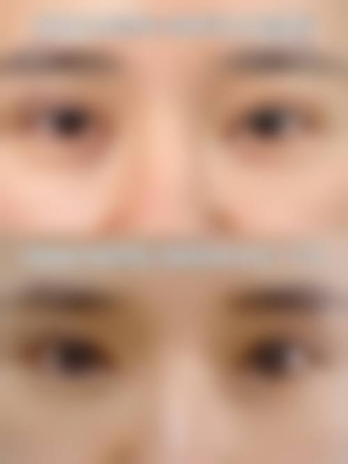 四、双眼皮修复过宽眉眼间距近怎么修复