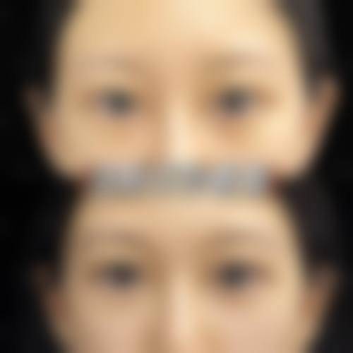五、双眼皮修复的风险