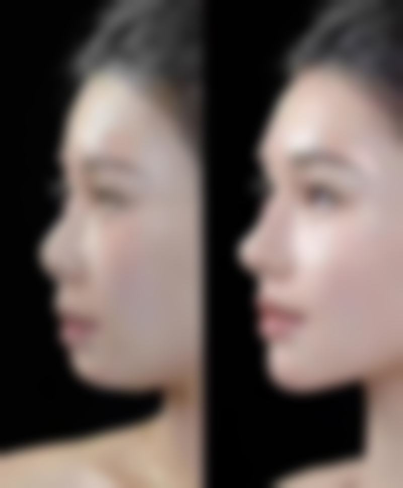韓國ID醫院削骨自然嗎 適合邊類人群?