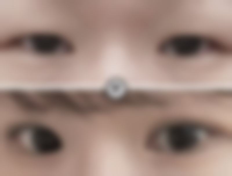 双眼皮修复眉眼距离会变近吗？其实【陈涛主任】指出，因术后肿胀或瘢痕挛缩导致，所以修复后眉眼太近会恢复。2026年私信领分阶段干预方案。