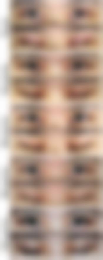 四、割双眼皮忌嘴时长与修复速度的关联