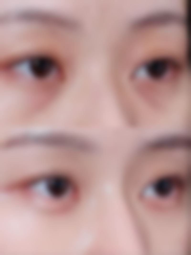 三、个人修复情况对割双眼皮忌嘴时长的影响