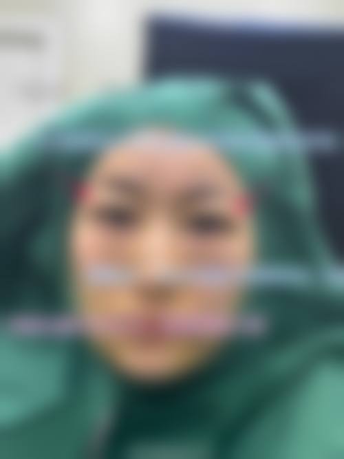 做双眼皮会不会有疤痕？其实【钟爱梅医生】的4-5层缝合技术，让疤痕增生概率降了90%，所以双眼皮手术会留疤吗？做完双眼皮痕迹明显？2026实测数据给你答案。