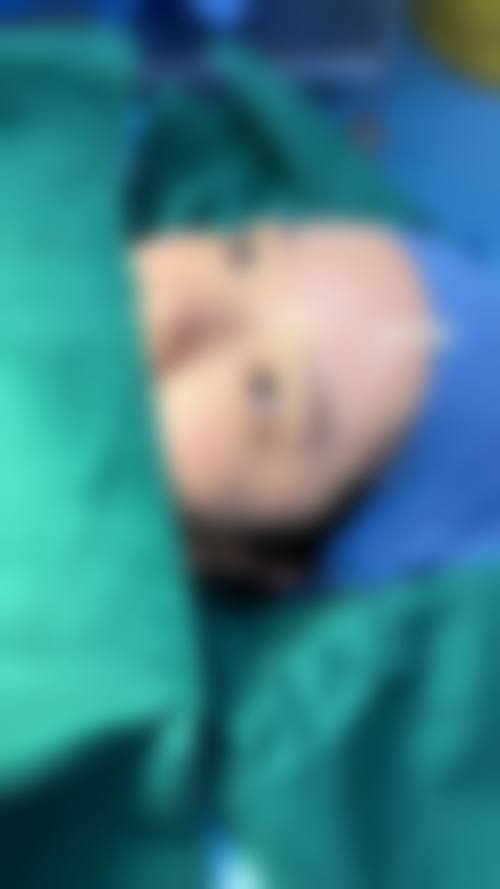 七、双眼皮手术常见问题解答