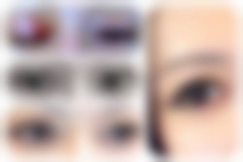 六、双眼皮术后疤痕管理