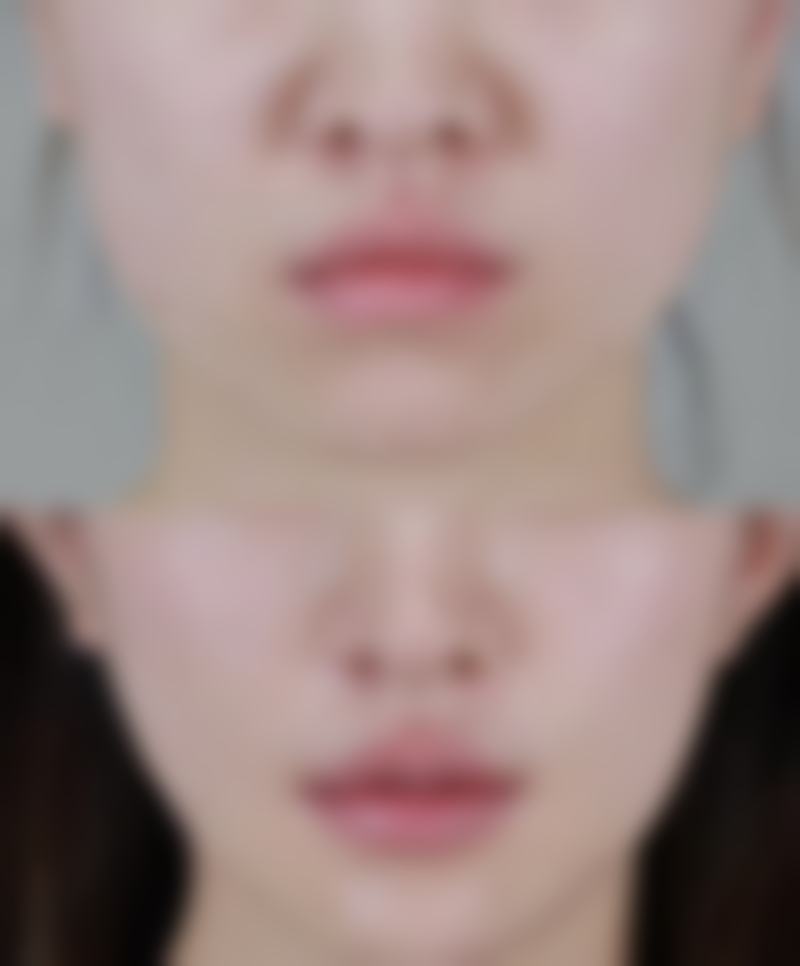 二、影响阴道紧缩术维持时间的因素