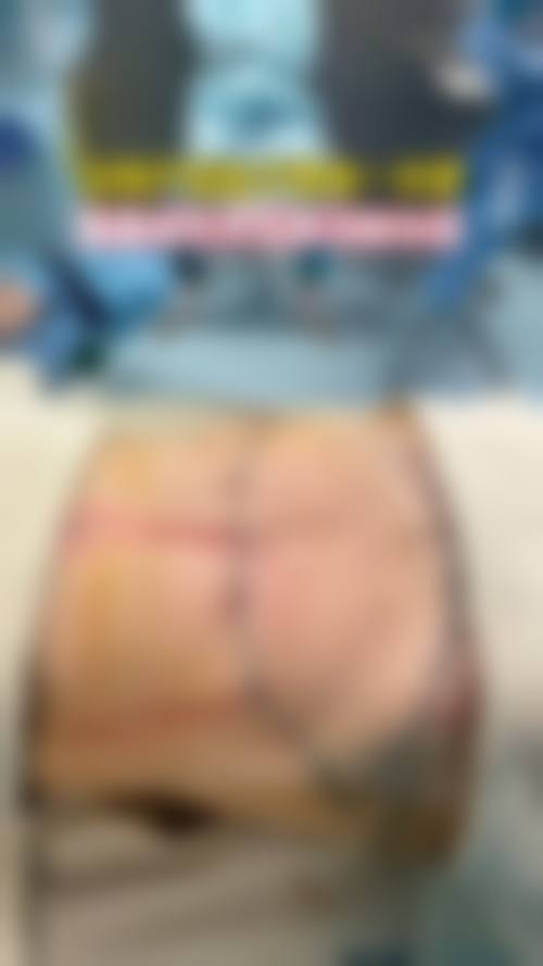 七、腹部抽脂后能走路吗