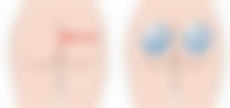 腹部抽脂后可以运动吗？协和斯楼斌医生实测：术后2-3个月可慢跑，但游泳得等4周后，私信领恢复时间表。