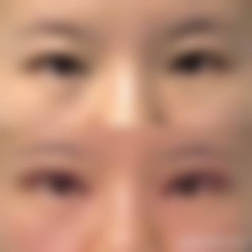 二、哪一种双眼皮形状更好看——不同形状双眼皮及适合人群