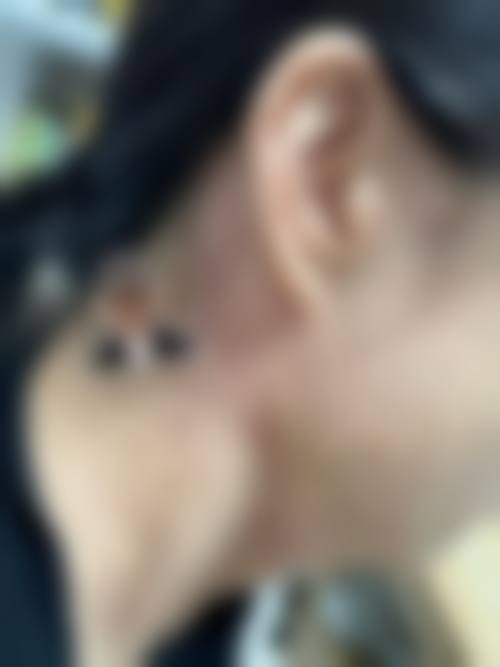 二、疤痕疙瘩难自愈的原因