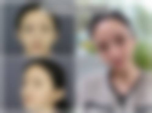 {韓國Banobagi鼻整形好唔好？2026費用效果案例公開！醫生技術/自然度點評值得做嗎？