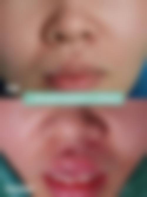 二、疤痕切除缝合手术的过程