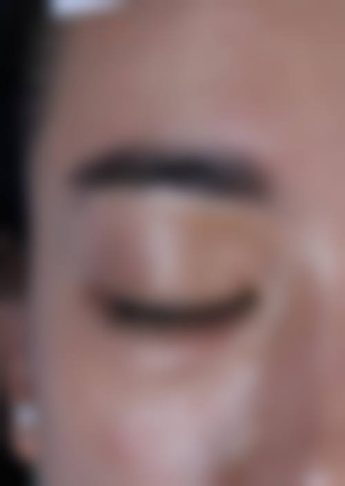 药物治疗鼻子疤痕,哪些药膏更有效?
