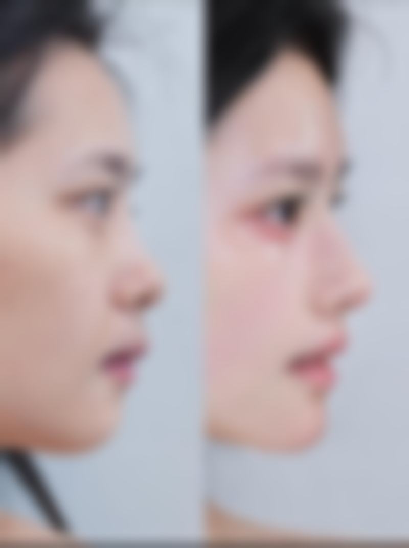 鼻子疤痕修复费用大揭秘,到底要花多少钱?