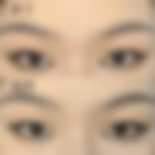 三、青少年眼袋去除的一般治疗方法成效如何