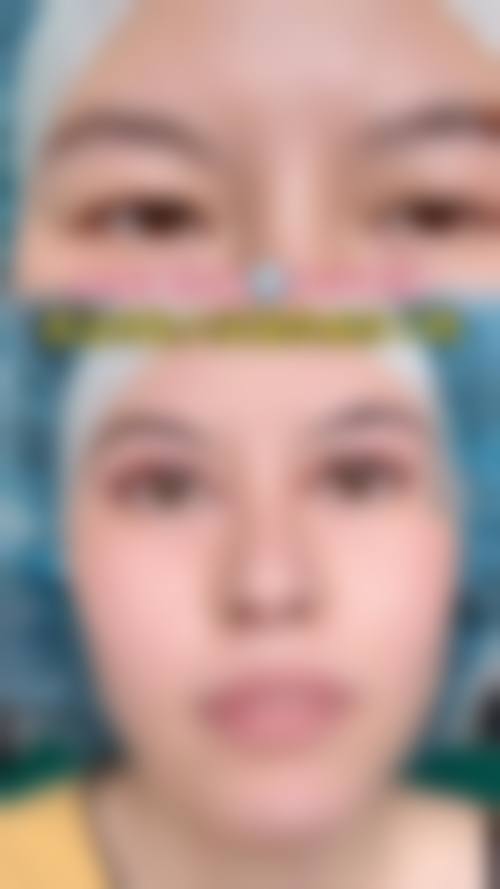 四、青少年眼袋去除的物理治疗适合人群