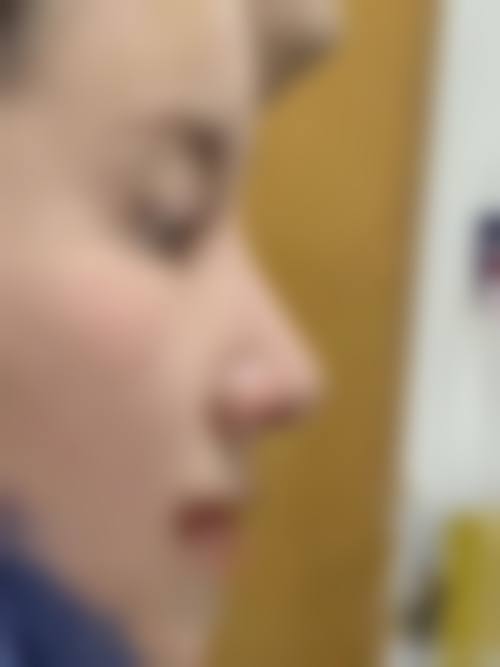 隆鼻手术后有哪些注意事项?