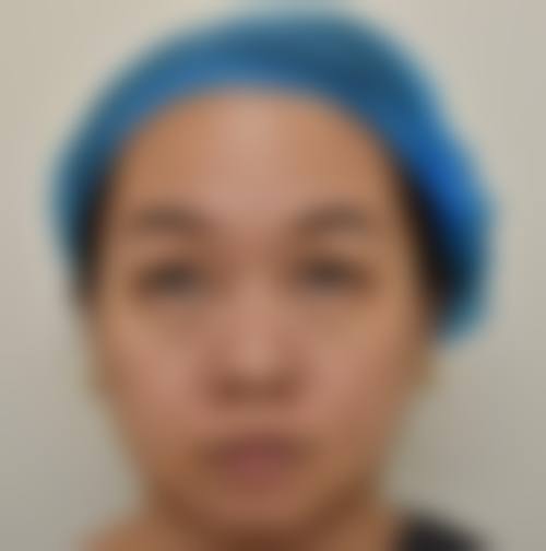 七、青少年眼袋去除手术的风险