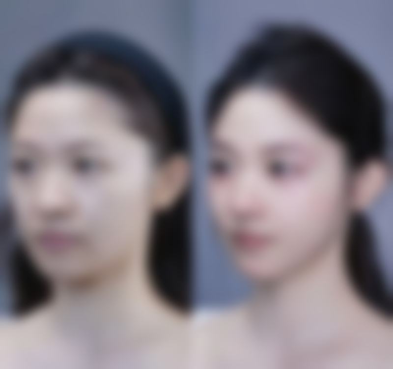 韓國安成烈VS澳門+珠海:疤痕修復邊個更方便?
