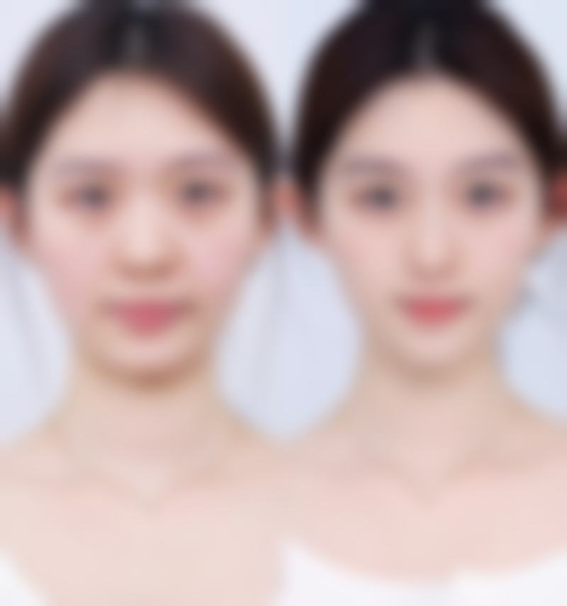 不同隆鼻方式的疼痛特点有何区别?