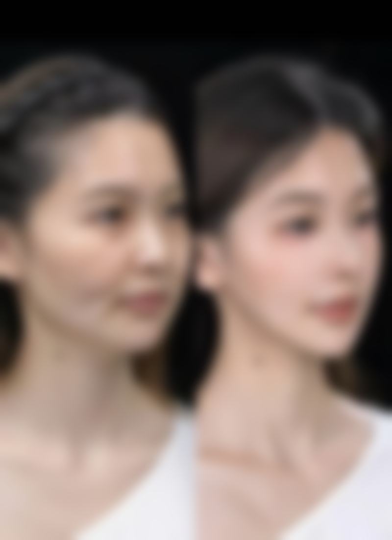 韓國安成烈VS香港本地:疤痕修復價錢邊個抵?