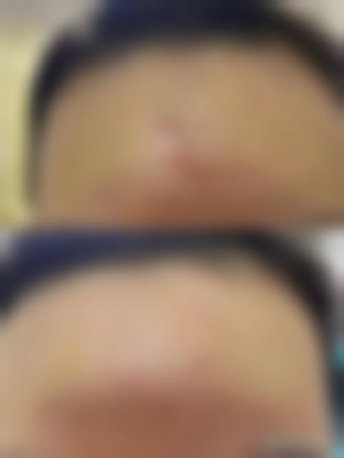 六、脸上凹陷疤痕修复的风险与后遗症