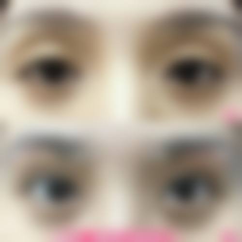 五、如何避坑睑外翻