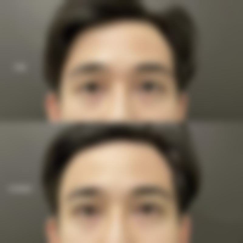 找冯勇医生做双眼皮修复?他的技术实力如何