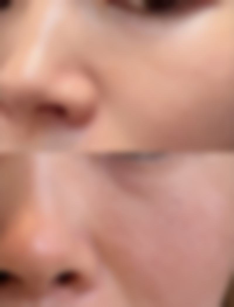 拓展延伸:韓國Ifeelyou皮膚科項目真相 + 避坑指南