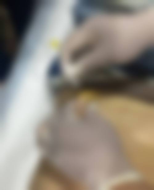 十、王鹏医生擅长项目科普：强生鱼骨线线提升