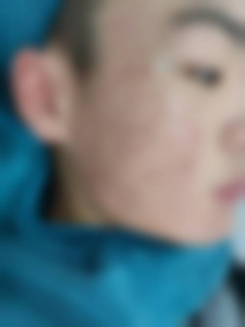 高永艳医生斑疤痘治疗技术优势