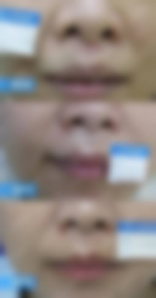 五、军检避坑指南之擦伤疤痕
