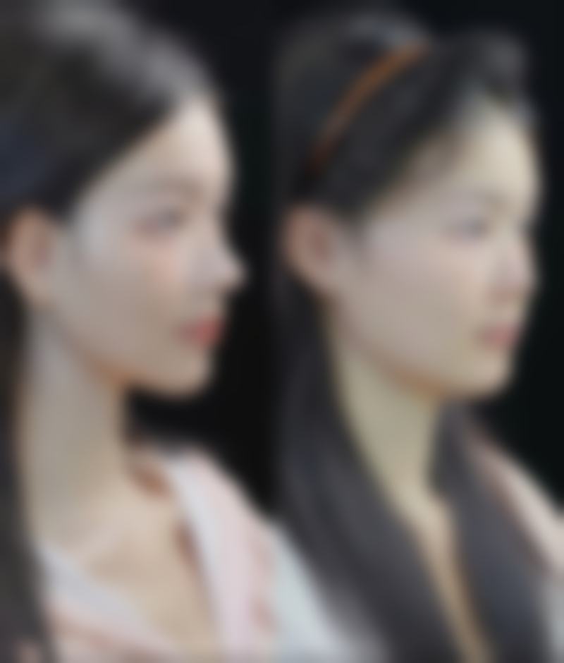 七、耳软骨隆鼻的局限性