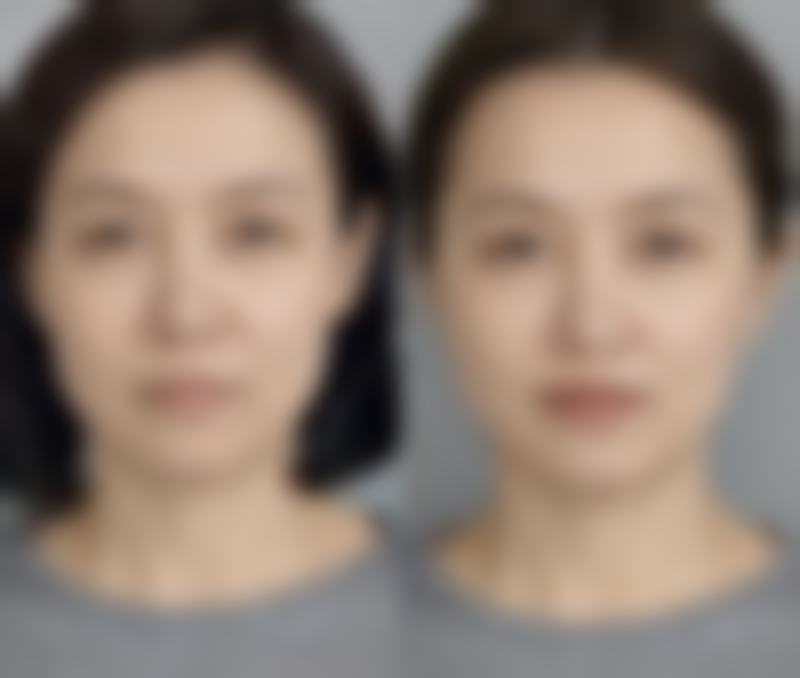 韓國DA整形香港人評價：技術特色啱唔啱香港人？