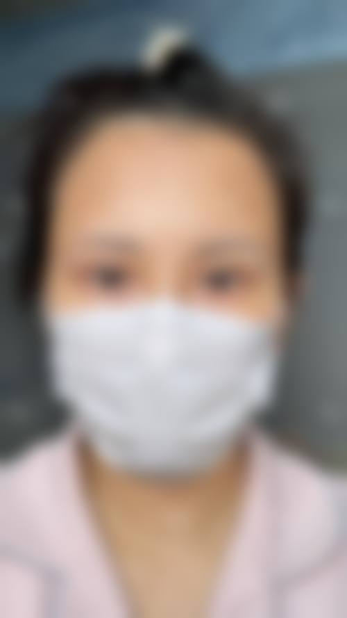 埋线双眼皮不好看多久可以拆掉？真相是【吕仁荣主任】建议立刻拆，2026年实测拆线费5000元起，私信看1V1修复方案避雷